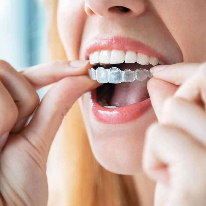 Woman Inserting Clear Orthodontic Aligner